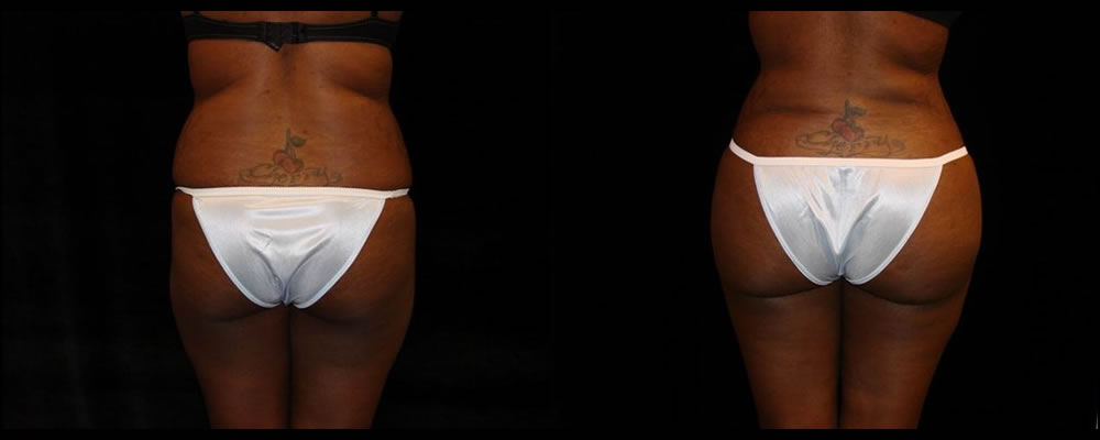 Brazilian Butt Lift Before & After Patient #634