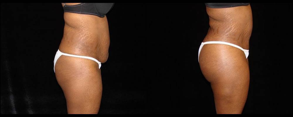 Brazilian Butt Lift Before & After Patient #634