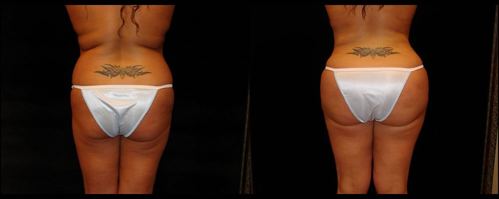 Brazilian Butt Lift Before & After Patient #630