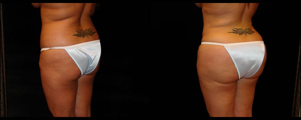 Brazilian Butt Lift Before & After Patient #630