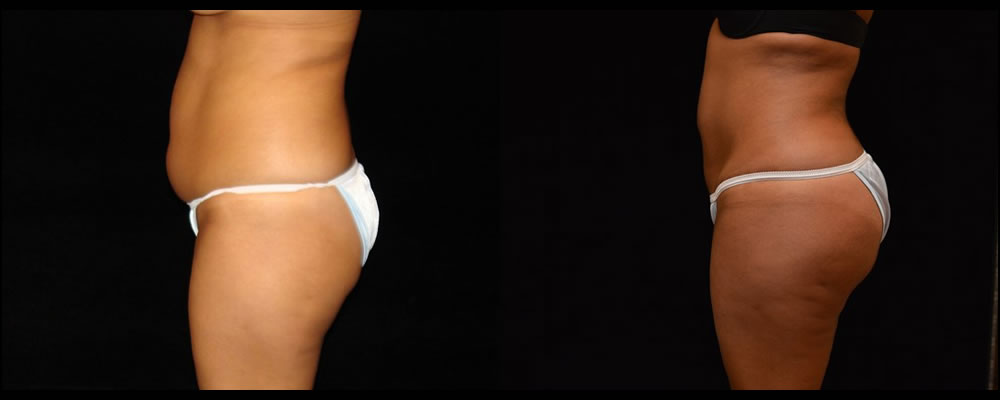 Brazilian Butt Lift Before & After Patient #628