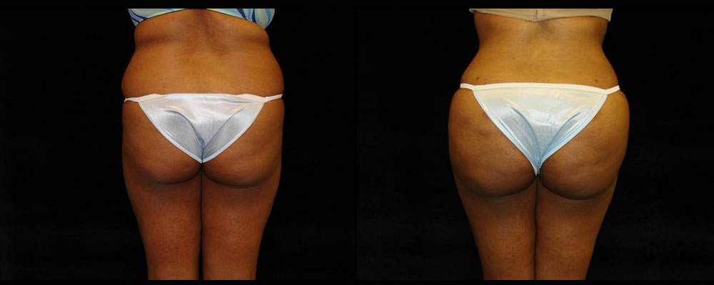 Brazilian Butt Lift Before & After Patient #764