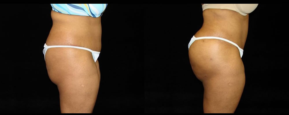 Brazilian Butt Lift Before & After Patient #764