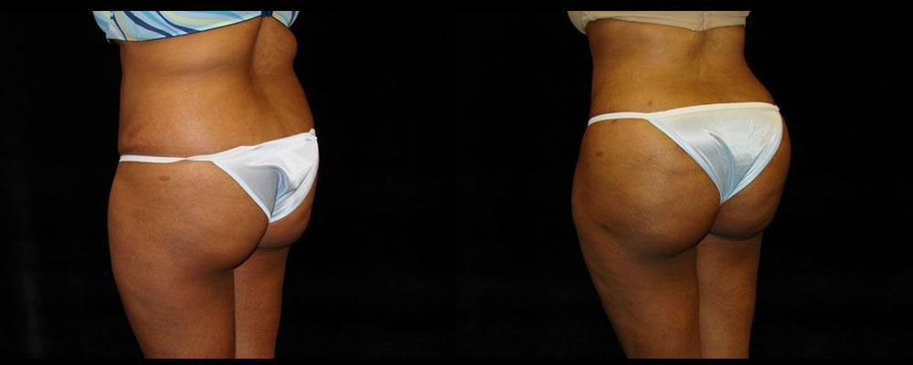Brazilian Butt Lift Before & After Patient #764