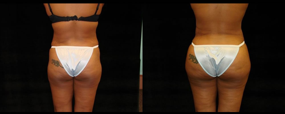 Brazilian Butt Lift Before & After Patient #759