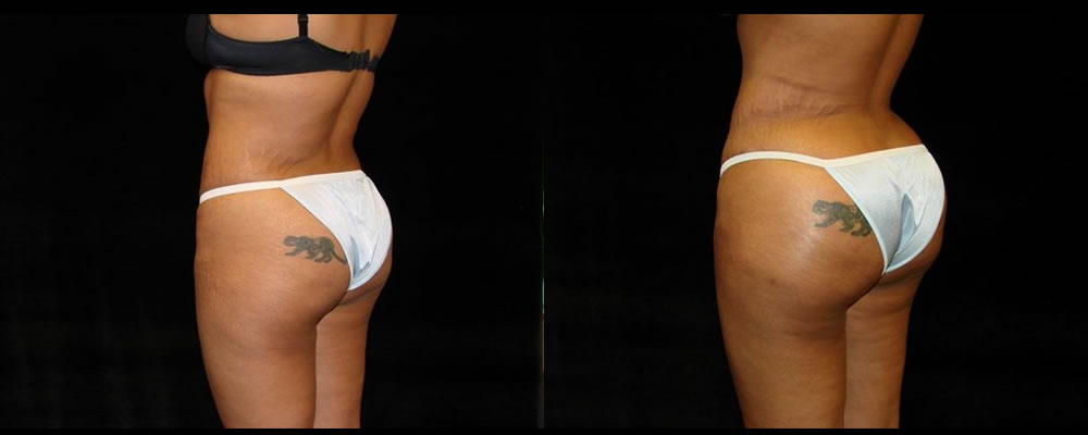 Brazilian Butt Lift Before & After Patient #759