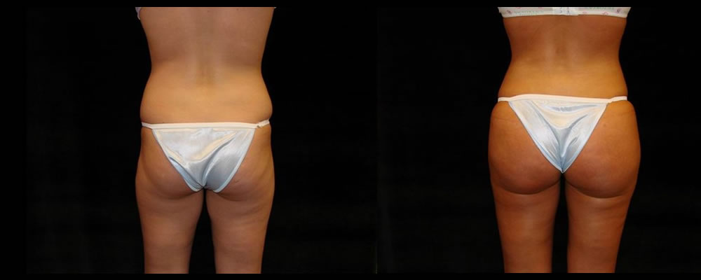 Brazilian Butt Lift Before & After Patient #755