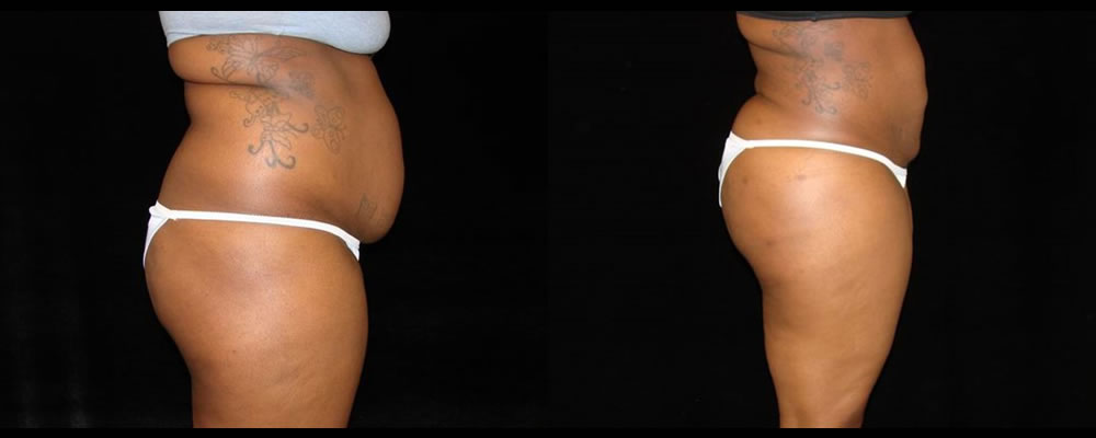 Brazilian Butt Lift Before & After Patient #755