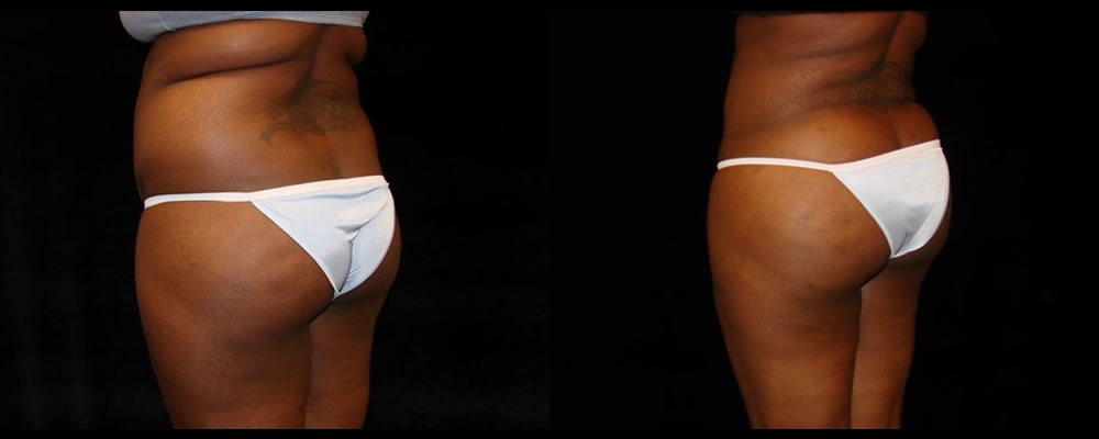 Brazilian Butt Lift Before & After Patient #755