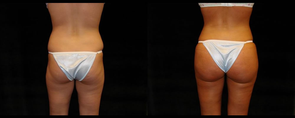 Brazilian Butt Lift Before & After Patient #751