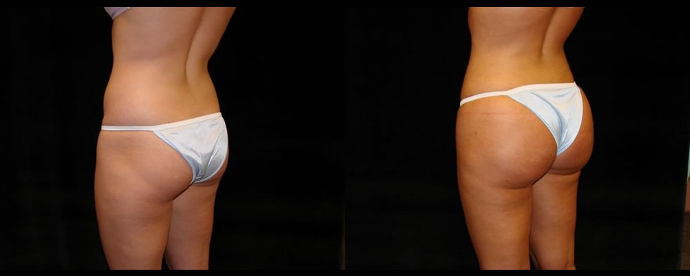 Brazilian Butt Lift Before & After Patient #751