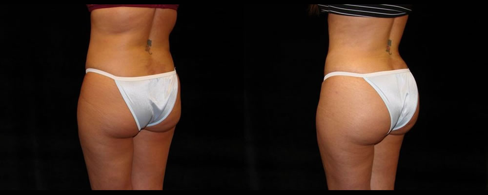 Brazilian Butt Lift Before & After Patient #747