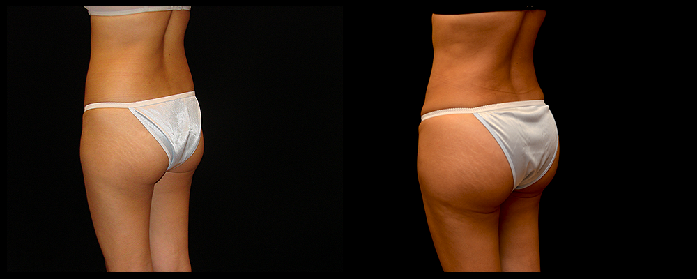 Brazilian Butt Lift Before & After Patient #620