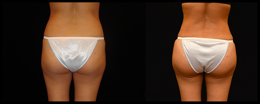 Brazilian Butt Lift Before & After Patient #620