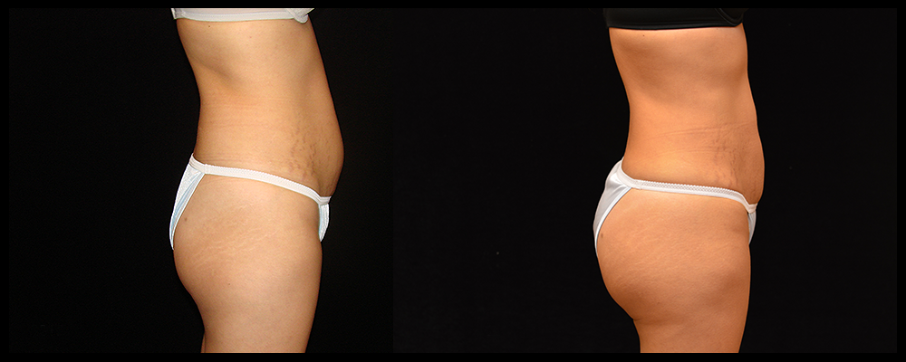 Brazilian Butt Lift Before & After Patient #620