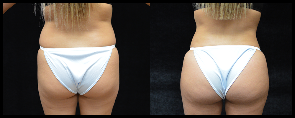 Brazilian Butt Lift Before & After Patient #616