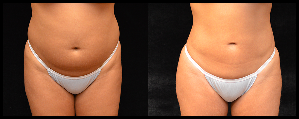 Brazilian Butt Lift Before & After Patient #616