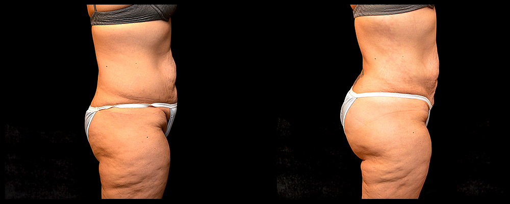 Brazilian Butt Lift Before & After Patient #612