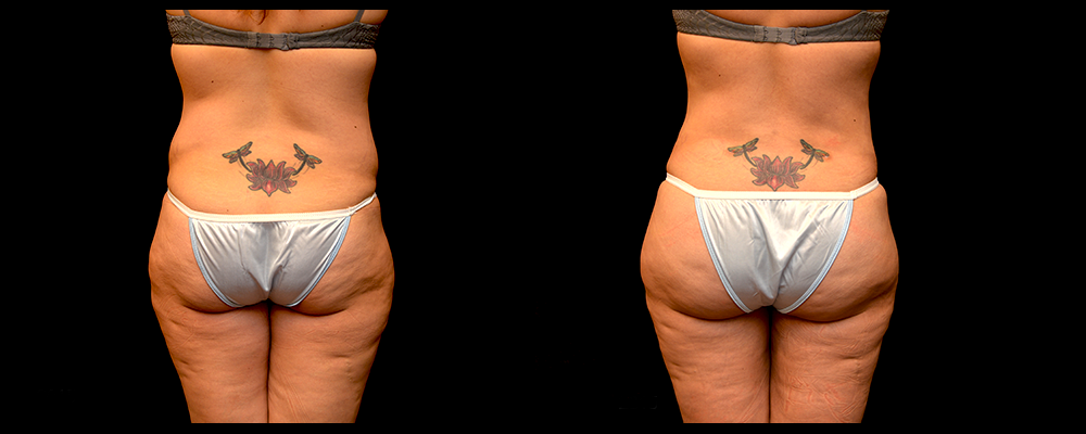Brazilian Butt Lift Before & After Patient #612