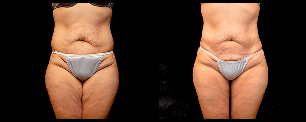 Brazilian Butt Lift Before & After Patient #612