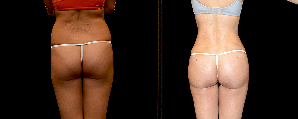 Brazilian Butt Lift Before & After Patient #789