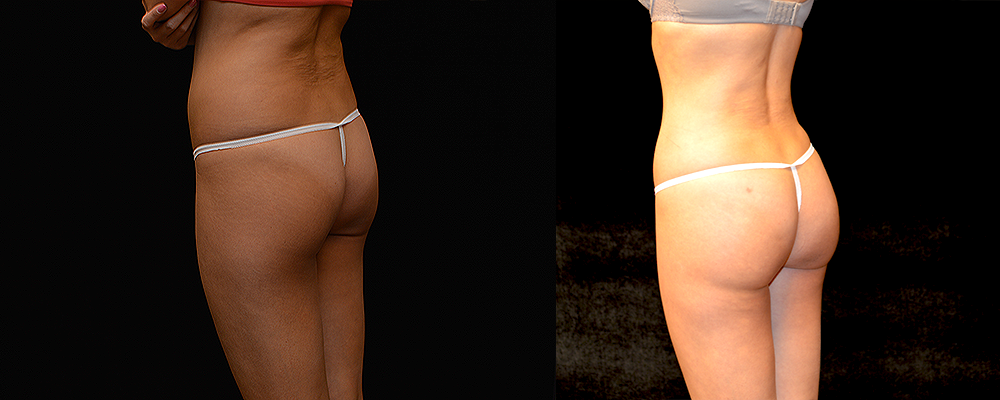 Brazilian Butt Lift Before & After Patient #789