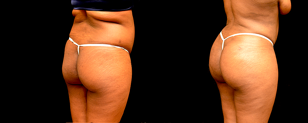 Brazilian Butt Lift Before & After Patient #785