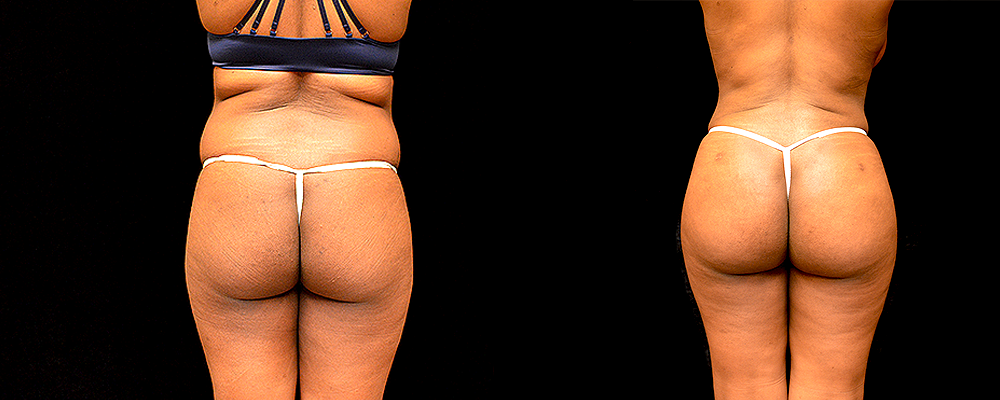 Brazilian Butt Lift Before & After Patient #785