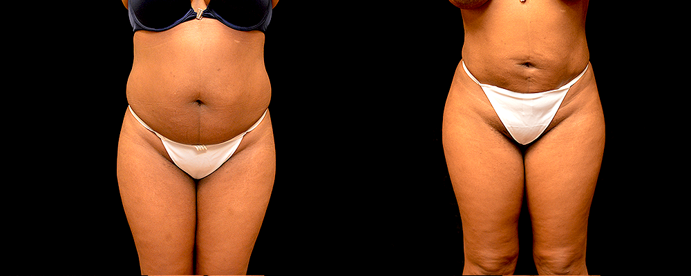 Brazilian Butt Lift Before & After Patient #785