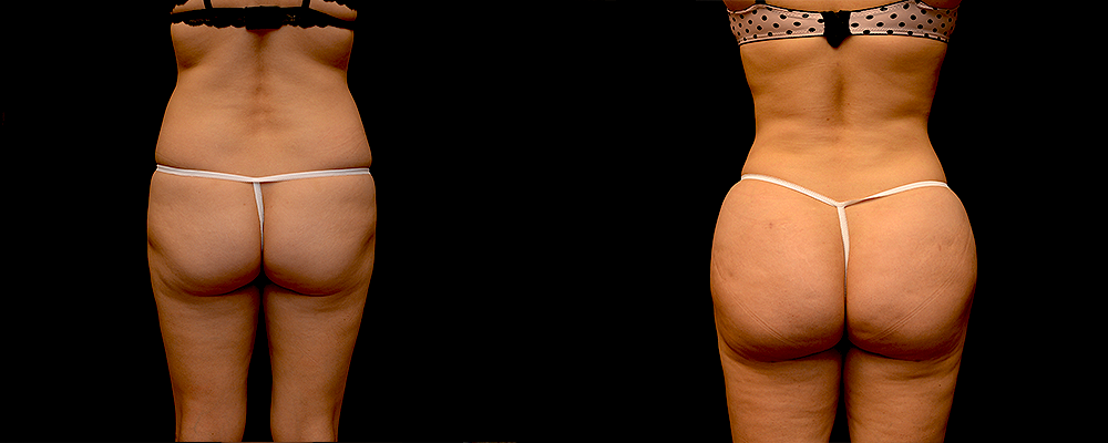 Brazilian Butt Lift Before & After Patient #781