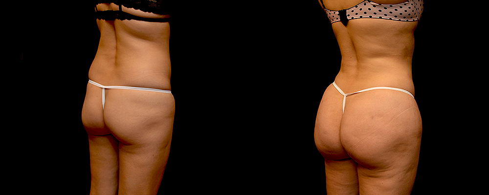 Brazilian Butt Lift Before & After Patient #781