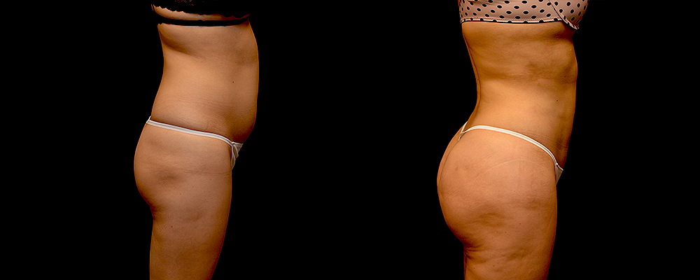 Brazilian Butt Lift Before & After Patient #781