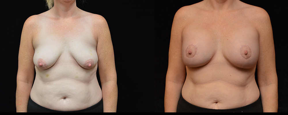 Breast Augmentation with Lift Before & After Patient #1017