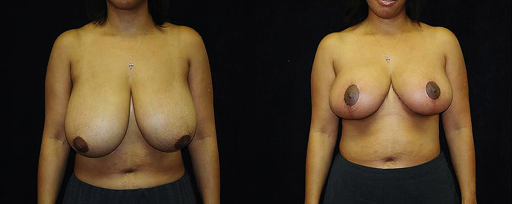 Breast Reduction Before & After Patient #1073