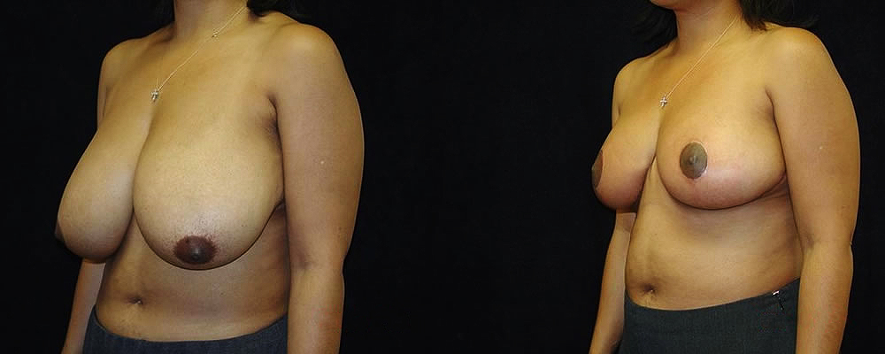 Breast Reduction Before & After Patient #1073