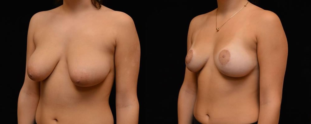 Breast Reduction Before & After Patient #1069
