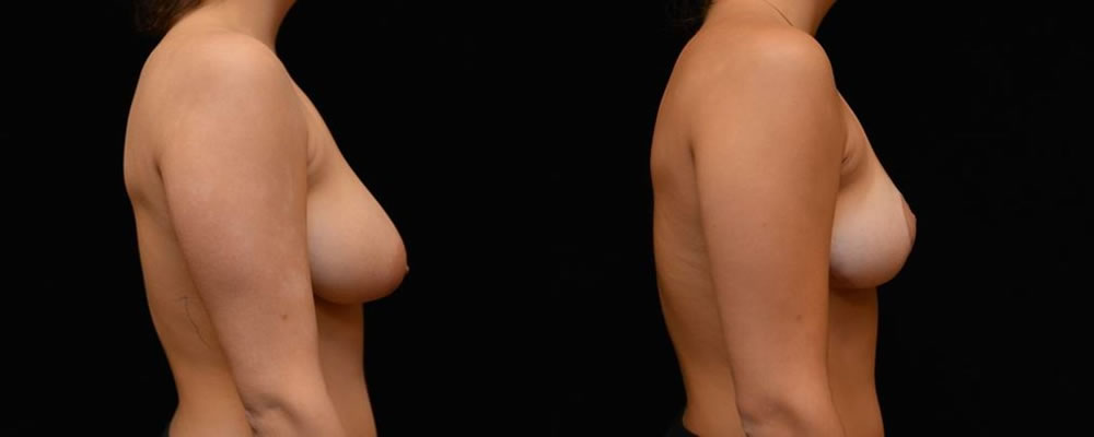 Breast Reduction Before & After Patient #1069