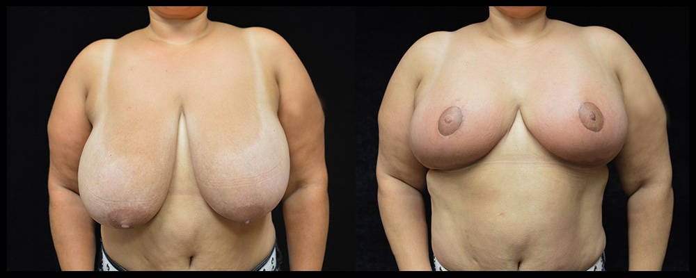 Breast Reduction Before & After Patient #1064