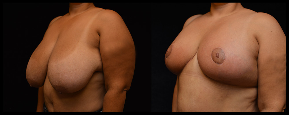 Breast Reduction Before & After Patient #1064