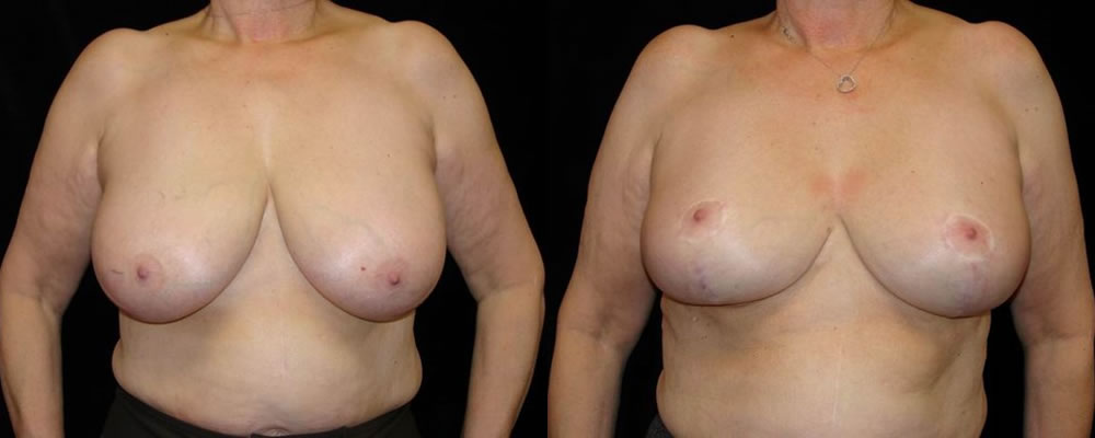 Breast Reduction Before & After Patient #1101