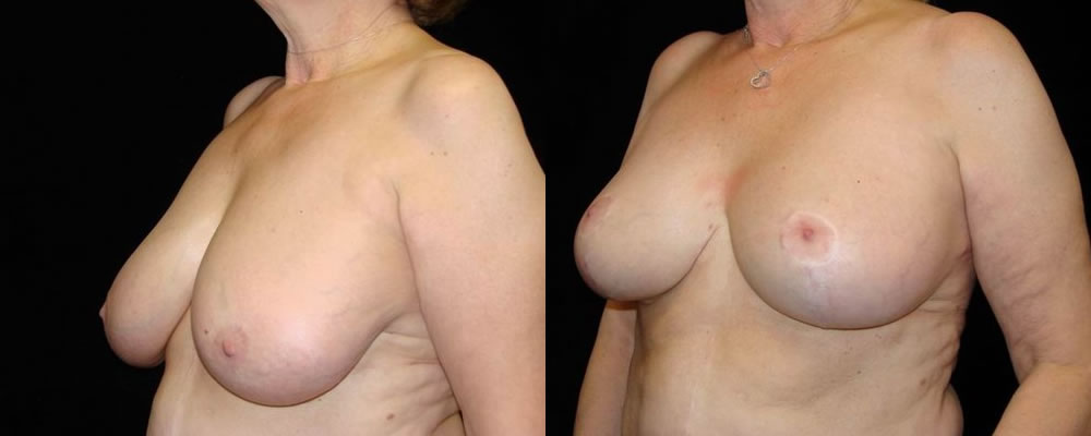 Breast Reduction Before & After Patient #1101