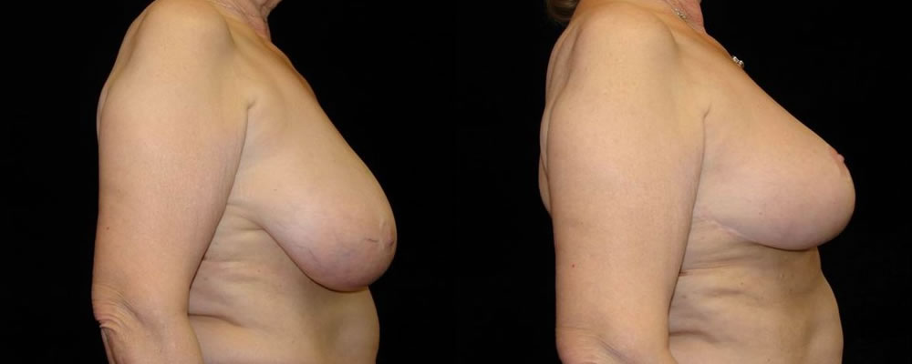 Breast Reduction Before & After Patient #1101