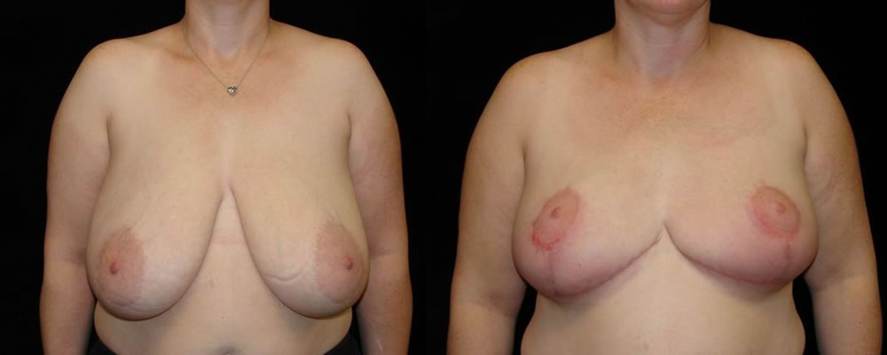 Breast Reduction Before & After Patient #1097