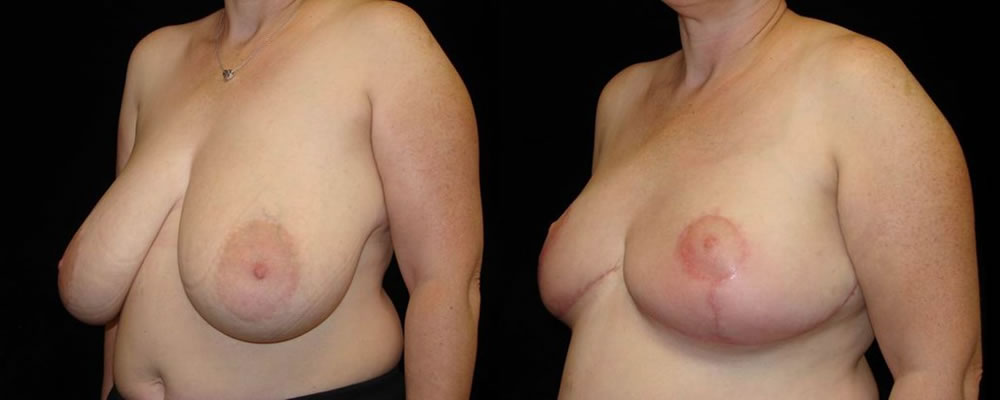 Breast Reduction Before & After Patient #1097