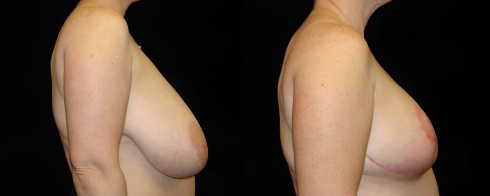 Breast Reduction Before & After Patient #1097