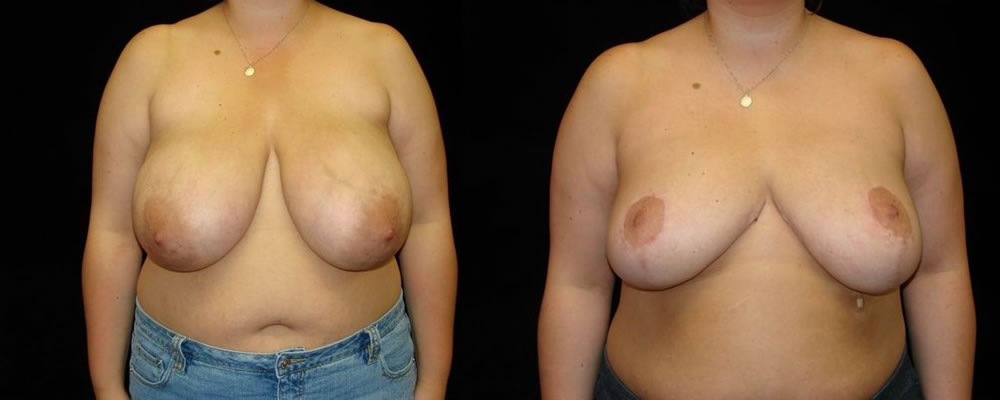 Breast Reduction Before & After Patient #1093