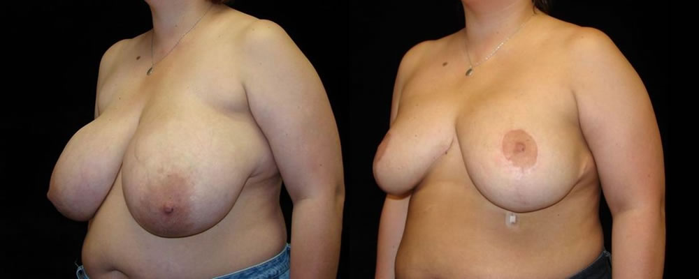 Breast Reduction Before & After Patient #1093