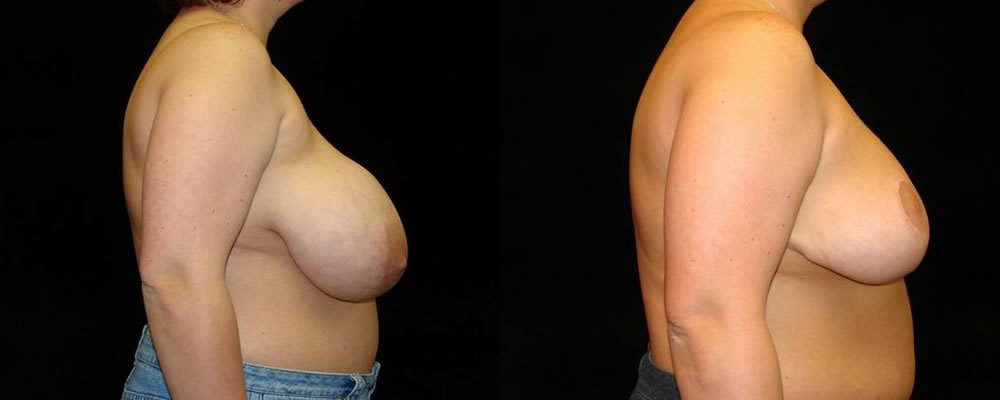 Breast Reduction Before & After Patient #1093