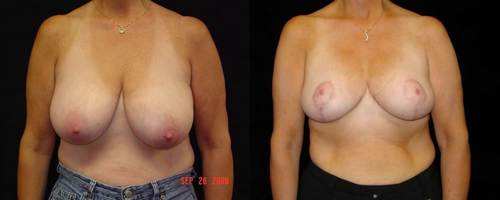 Breast Reduction Before & After Patient #1089