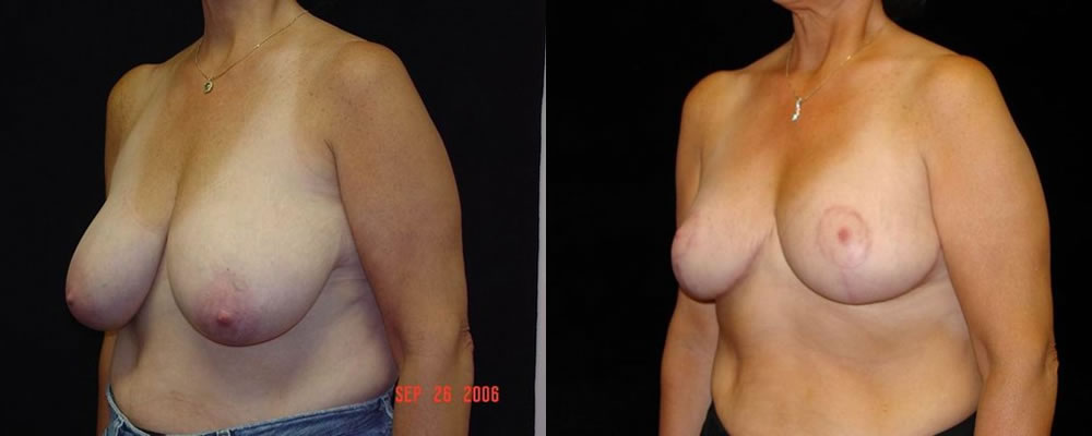 Breast Reduction Before & After Patient #1089